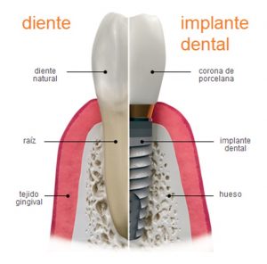 implante dental puerto santa maría