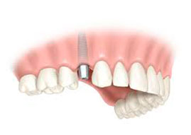 implantes dentales puerto santa maría