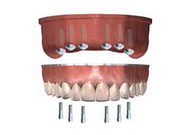 implantes dentales puerto santa maría