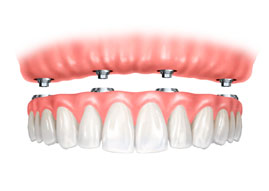 implantes dentales puerto santa maría