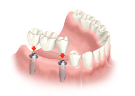 implantes dentales puerto santa maría