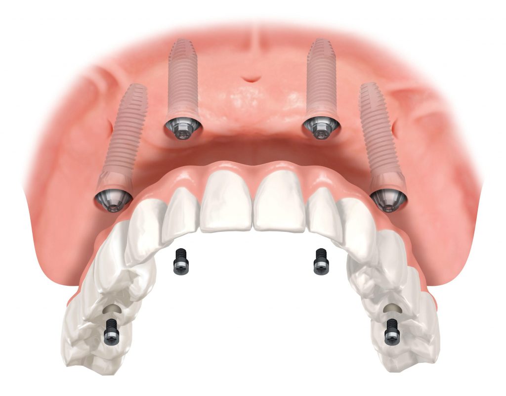 implantes dentales puerto santa maría