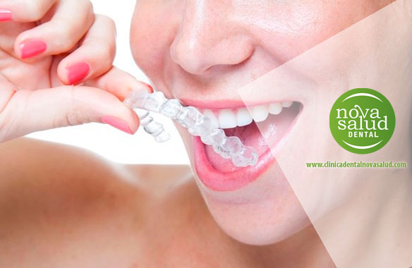 invisalign puerto santa maria