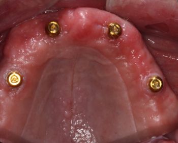 4 implantes en el maxilar superior
