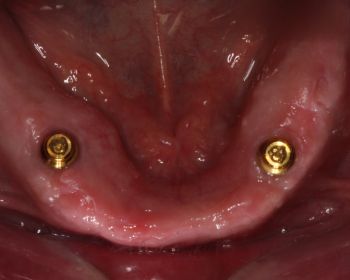 2 implantes en el maxilar inferior