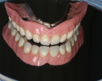 Prótesis maxilar superior implantes dentales puerto santa maria