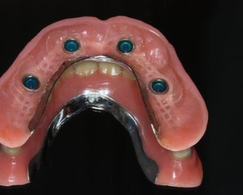 4 implantes en el maxilar superior