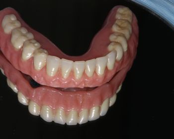 Prótesis maxilar inferior implantes dentales puerto santa amria