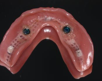 2 implantes en el maxilar inferior