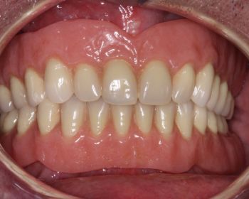 REHABILITACIÓN COMPLETA implantes dentales puerto santa amria