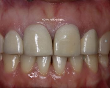 Antes prótesis dental puerto santa maria