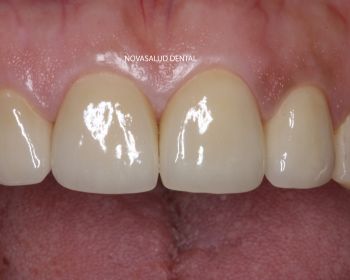 Después protesis dental puerto santa maría