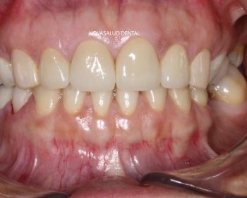 Después protesis dental puerto santa maría