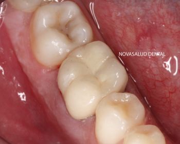 Después estética dental puerto santa maría