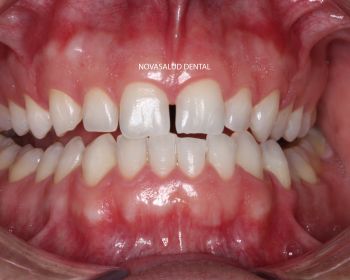 Después del blanqueamiento dental en domicilio