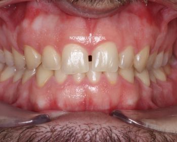 Antes del blanqueamiento dental en domicilio