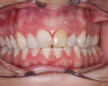 Antes blanqueamiento dental puerto santa maria