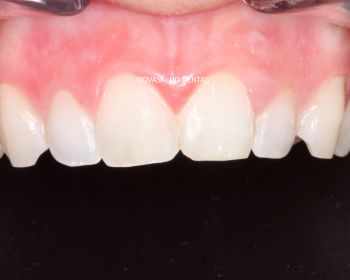 Después blanqueamiento dental puerto santa maria