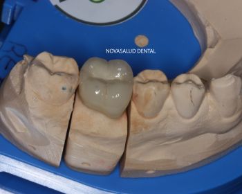En proceso protesis dental puerto santa maria